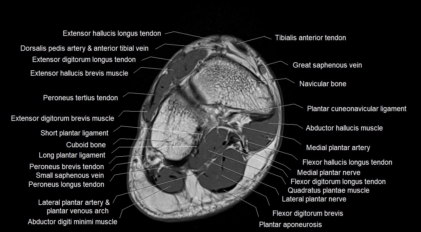 MRI 3T foot axial cross sectional anatomy image 5.webp
